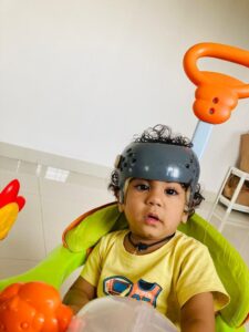 Rare Surgery for a Baby with Fused Skull