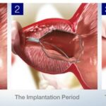 Revolutionary iTIND Solution for Urinary Issues in Youth at AINU